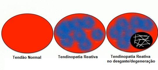 Evolução da tendinopatia no tendão