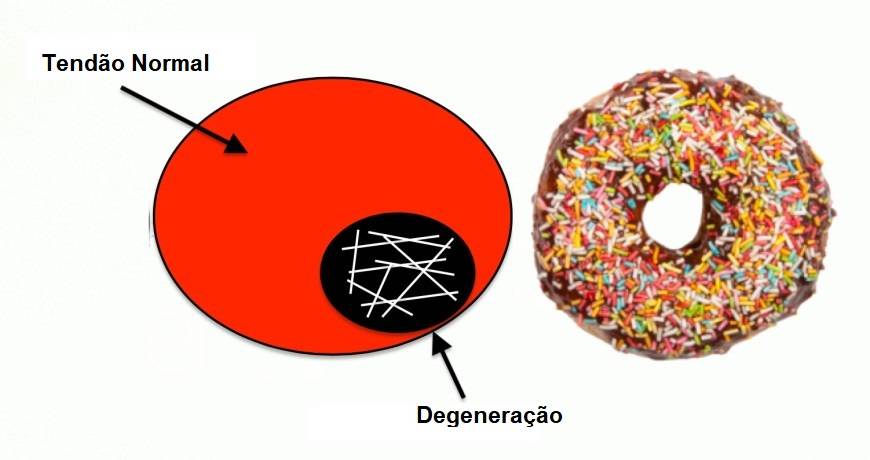 Comparação do tendão com degeneração a uma rosquinha