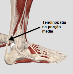 Tendinopatia na porção média do tendão de Aquiles