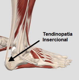 Tendinopatia na inserção entre o tendão de Aquiles e o calcâneo