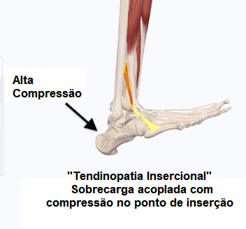 Alta compressão na tendinopatia insercional